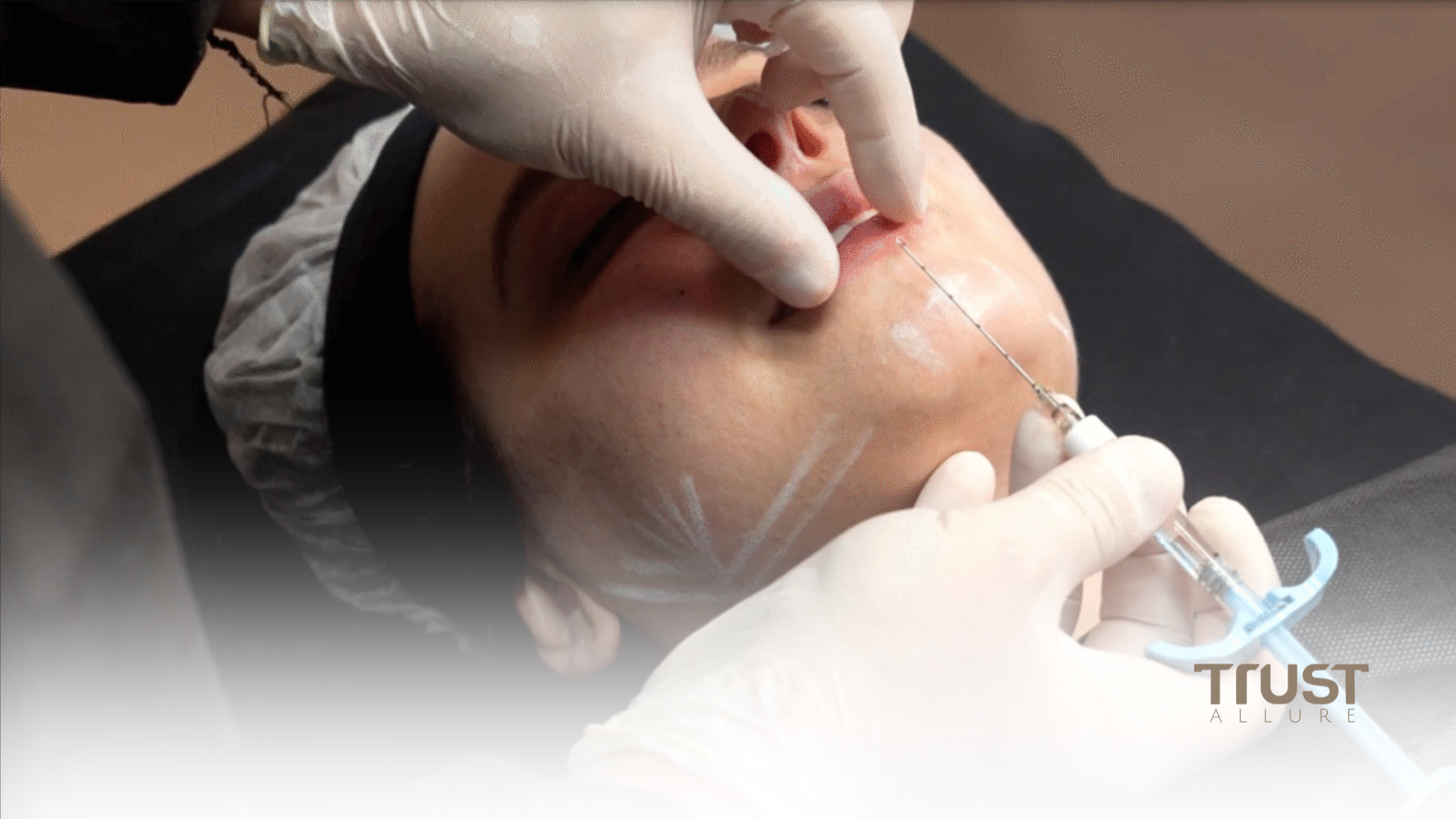Preenchimento facial x Skinbooster: qual é o melhor para cada caso? 